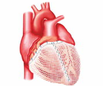 Figure 3.Medical textiles working as a cardiac support device